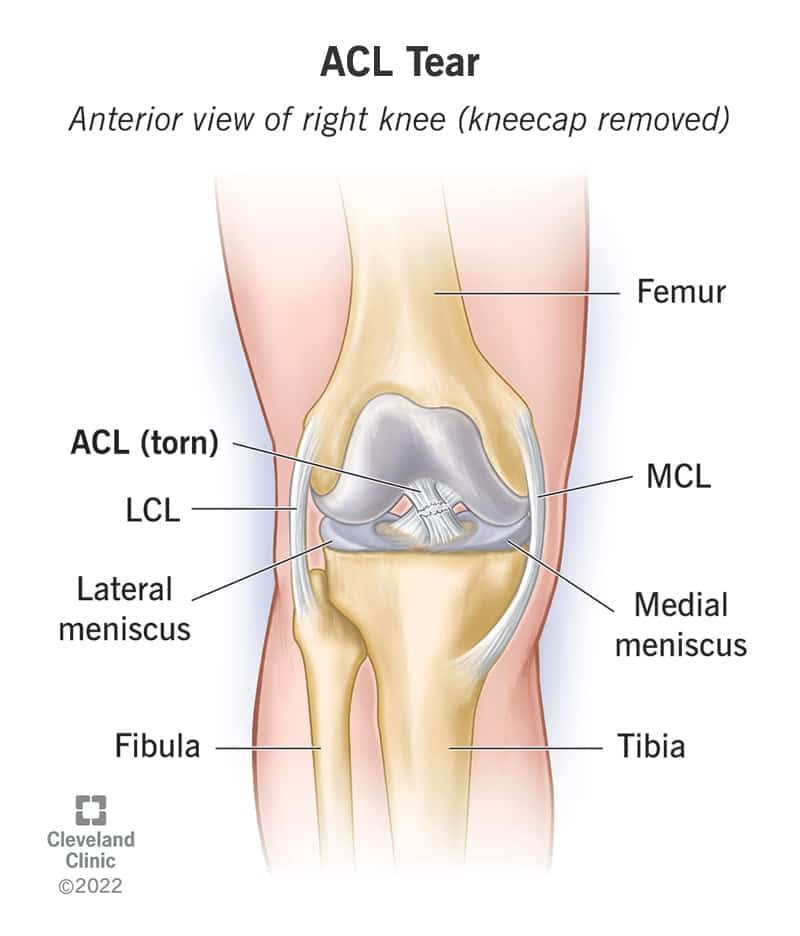 16576 acl tear