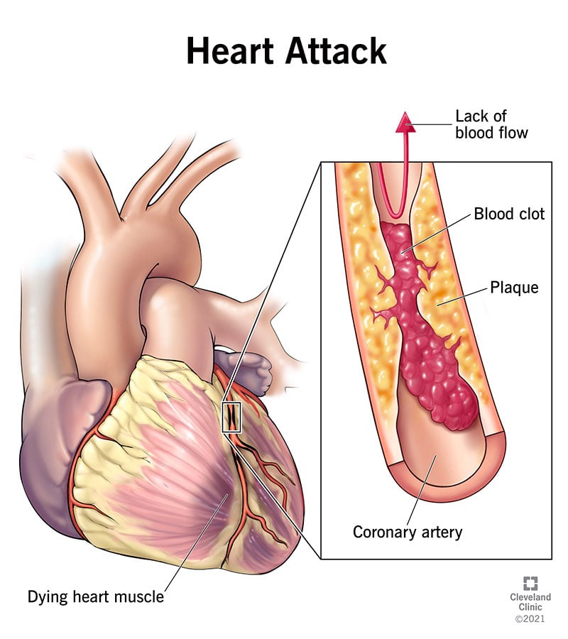 16818 heart attack illustration