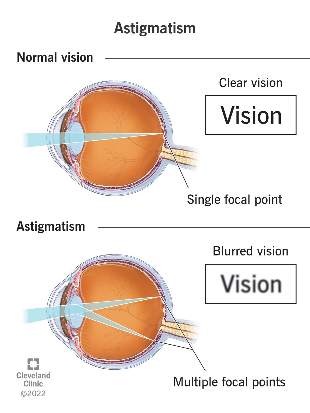 Illustratsioon, mis näitab, kuidas astigmatism põhjustab nägemise hägustumist