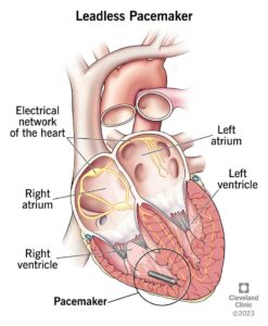 17166 leadless pacemaker illustration