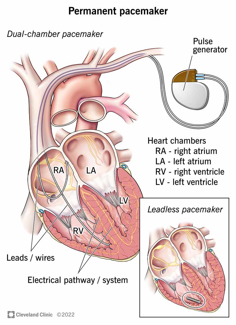 Näited püsivatest südamestimulaatoritest, mis aitavad südamel normaalses rütmis töötada.
