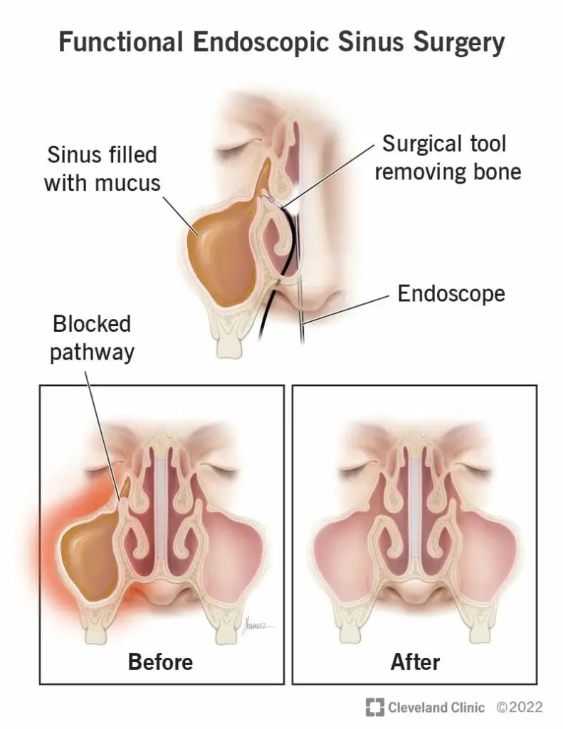 17478 functional endoscopic sinus surgery