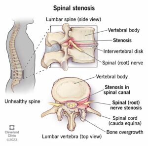 17499 spinal stenosis 02