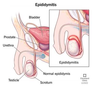 17697 epididymitis