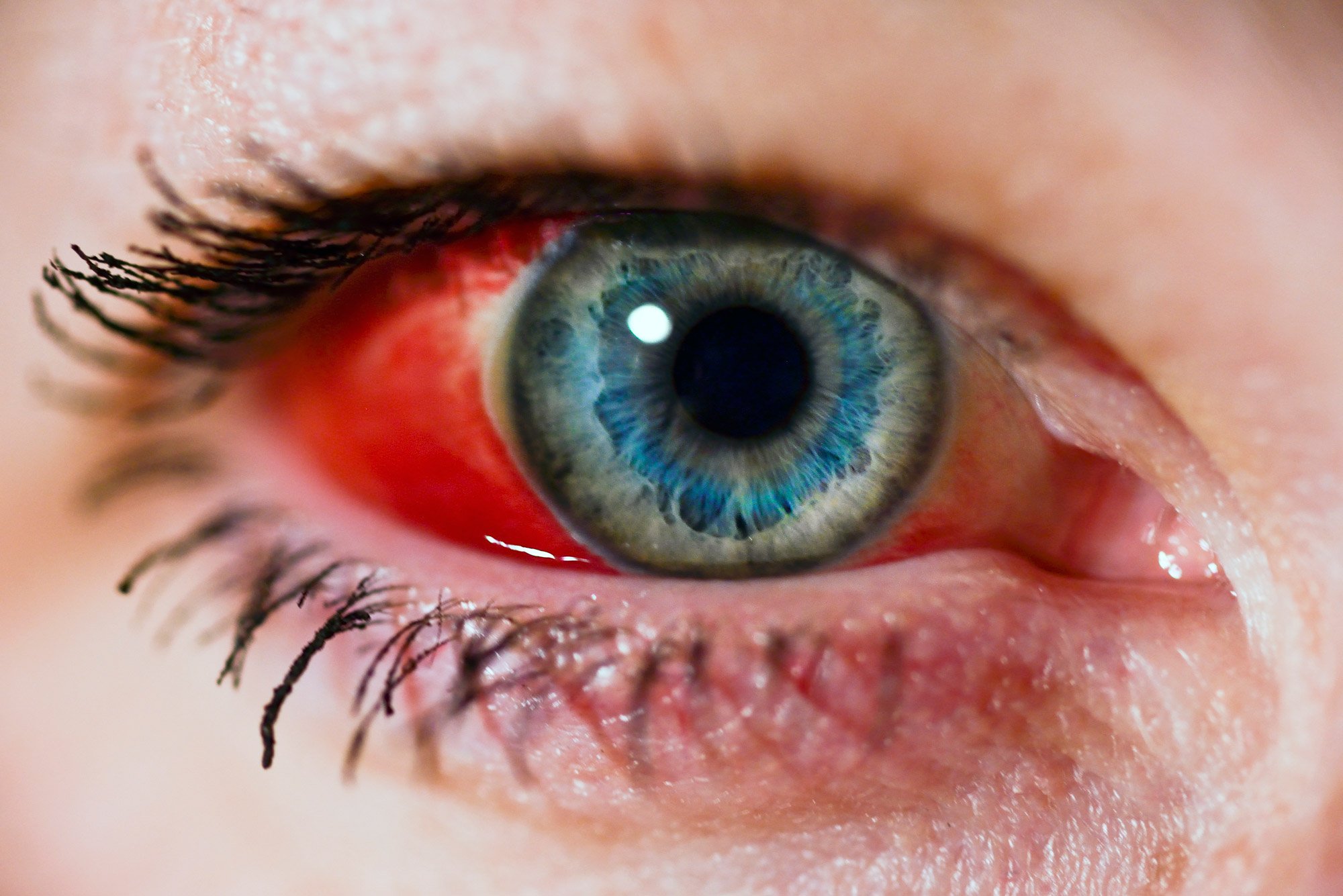 Subkonjunktivaalne hemorraagia inimese silma pinnal.