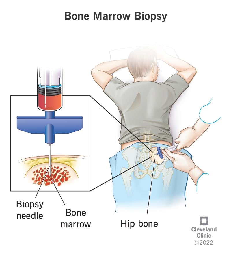 17735 bone marrow biopsy