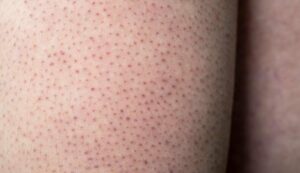 17758 keratosis pilaris 1332694298