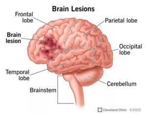 17839 brain lesions