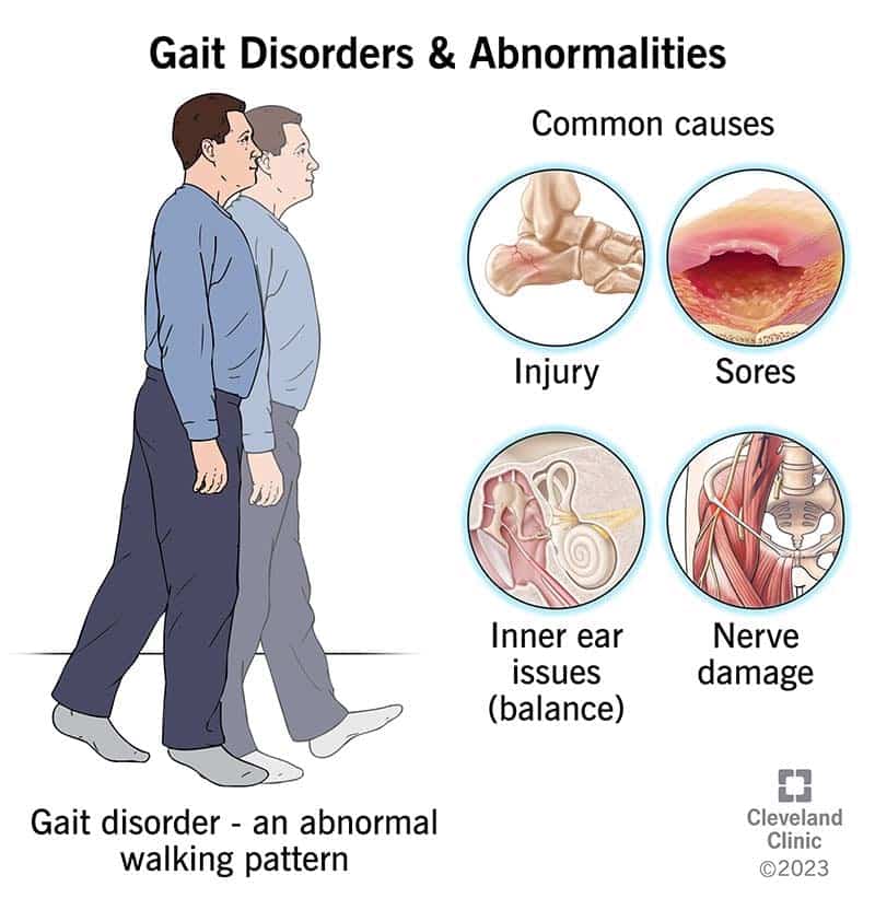 21092 gait disorders