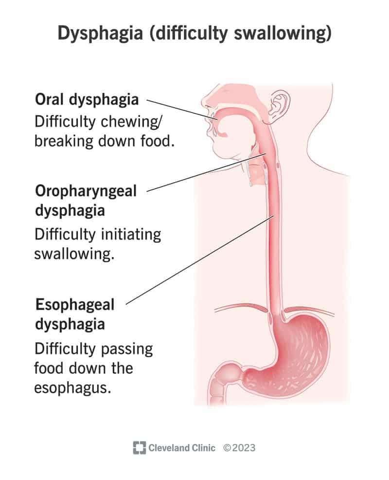 21195 dysphagia difficutly swallowing