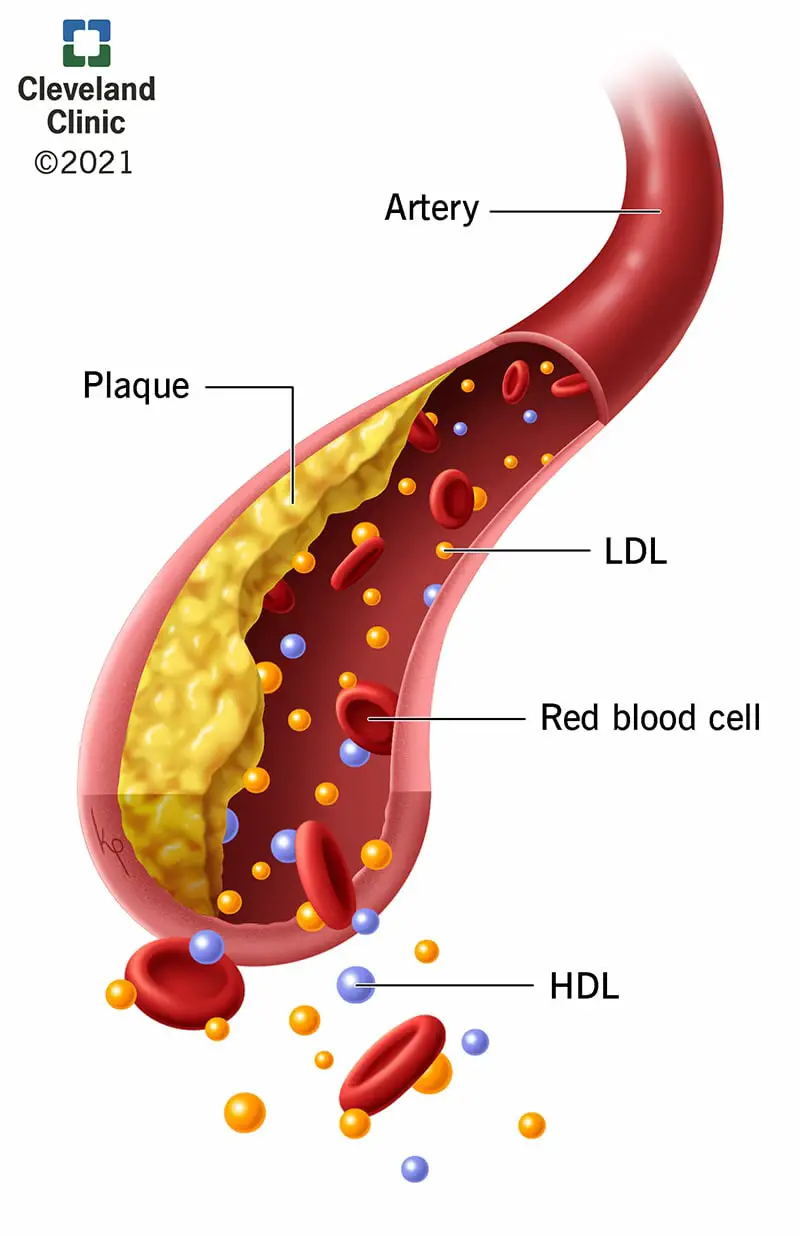 LDL, HDL ja tahvel arteris.