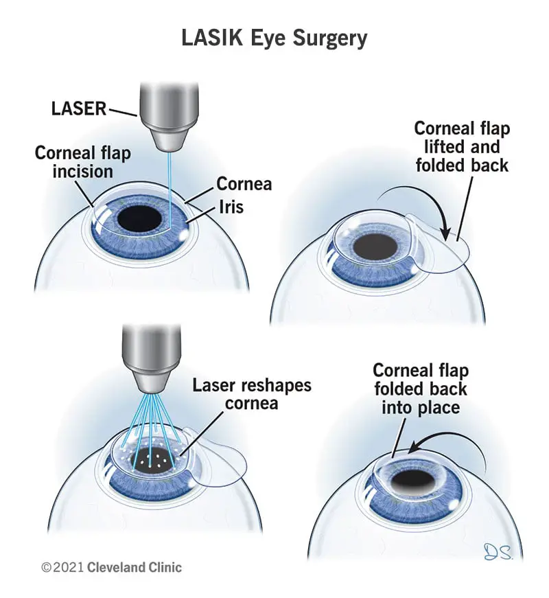 Illustratsioon, mis näitab LASIK-i silmaoperatsiooni etappe.