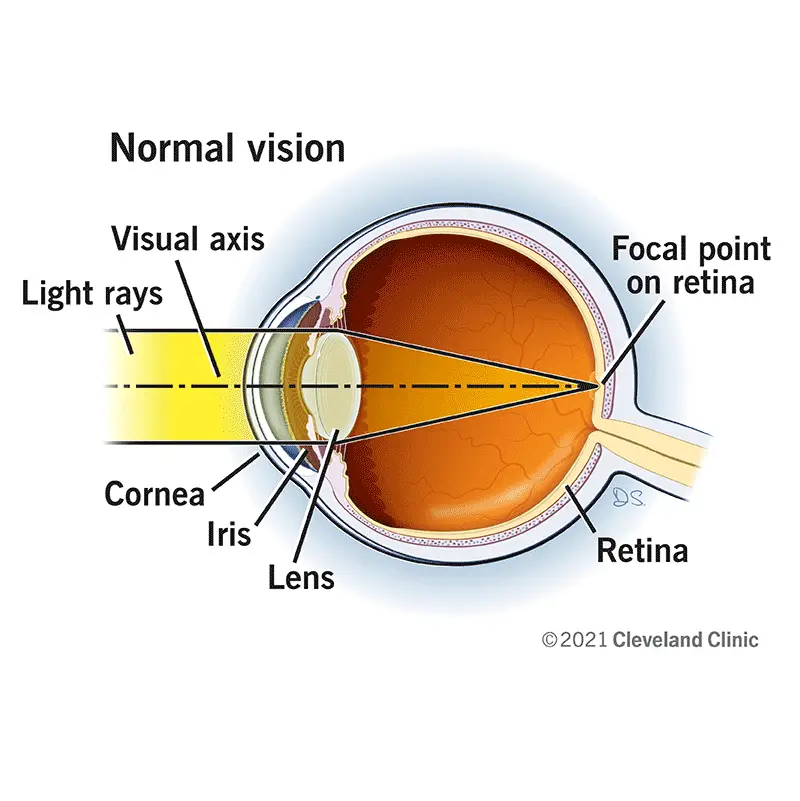 lasik-silmakirurgia-sfomc