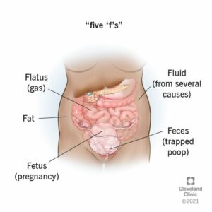 21819 distended abdomen.ashx