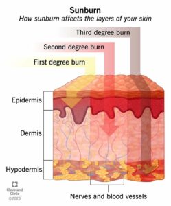 21858 sunburn