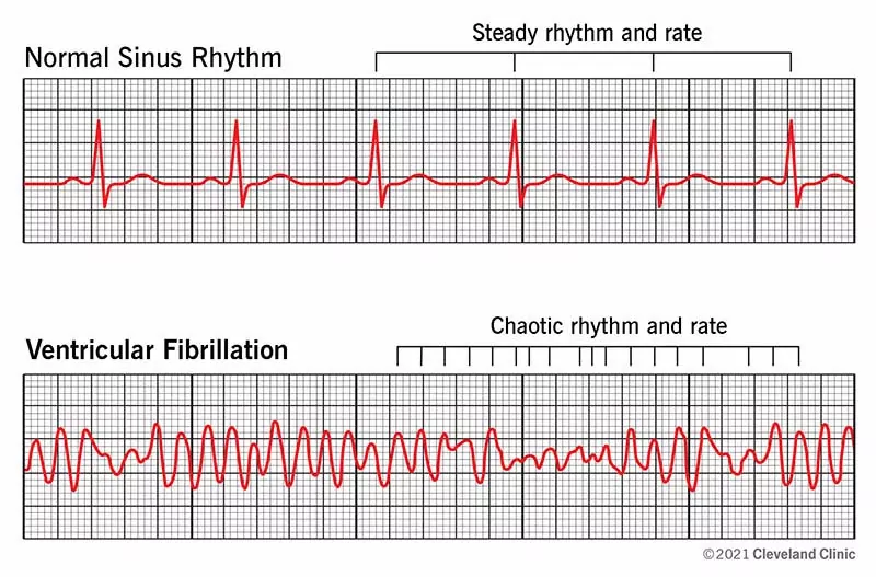 21878 ventricular fibrillation illustration