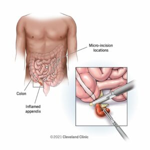 21922 appendectomy ddsi.ashx