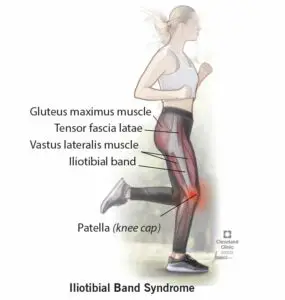 21967 Iliotibial band syndrome