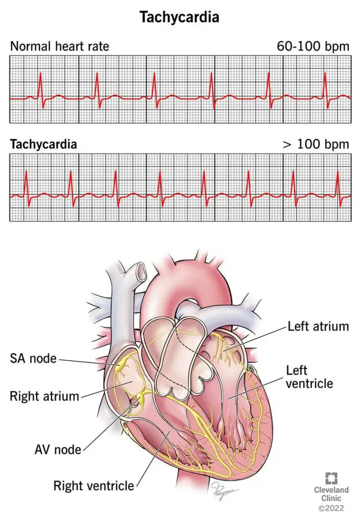 22108 tachycardia illustration