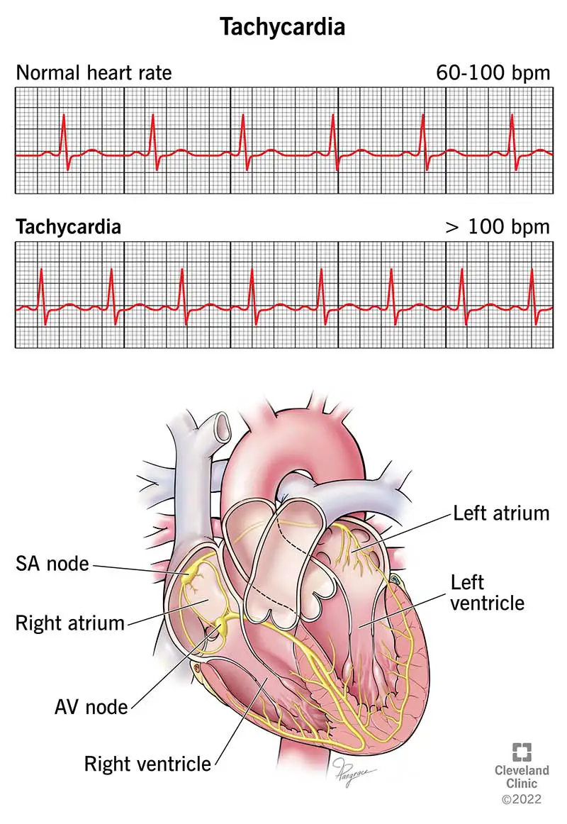 EKG üle 100 löögi minutis (puhkeolekus) näitab tahhükardiat.