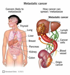 22213 metastatic cancer