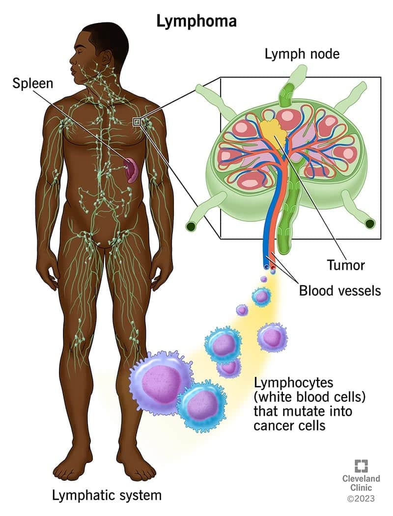 Lümfoom on vähk, mis saab alguse teie valgetest verelibledest (lümfotsüütidest).  Teil on kogu kehas lümfisõlmed.  Paistes lümfisõlm võib olla märk lümfoomist teie lümfisõlmes.