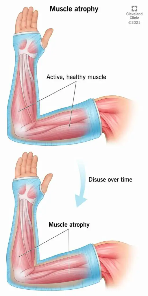 22310 muscle atrophy