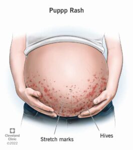 22374 puppp rash