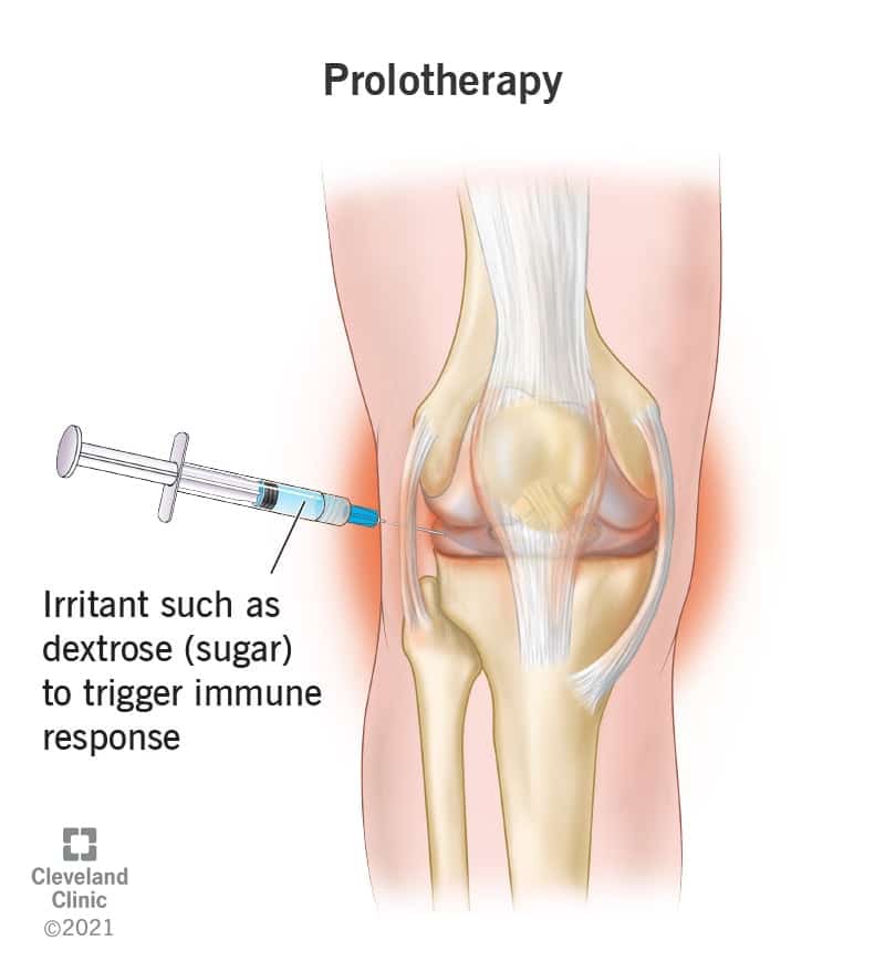 22426 prolotherapy
