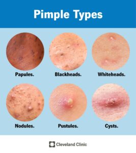 22468 pimples