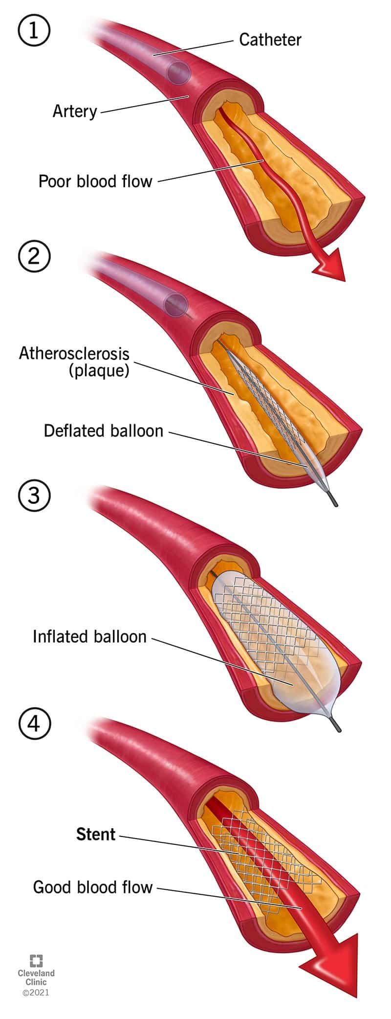 Stent on väga väike toru, mille teie tervishoiuteenuse osutaja võib teie arterisse panna, et see lahti hoida.