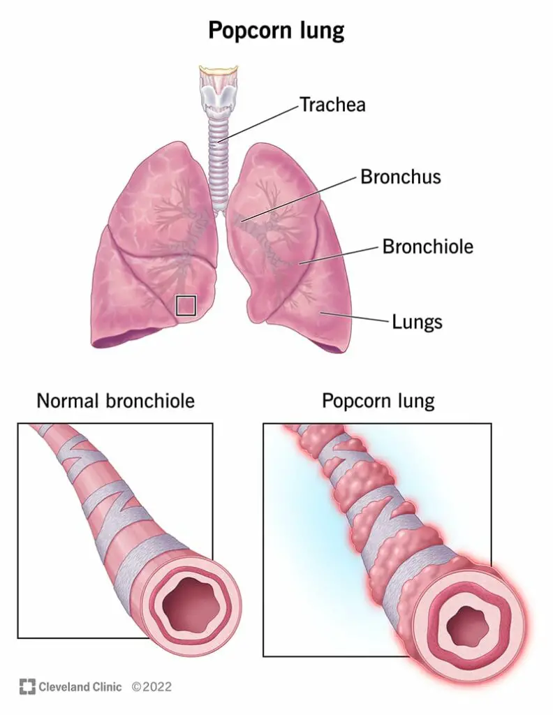 22590 popcorn lung