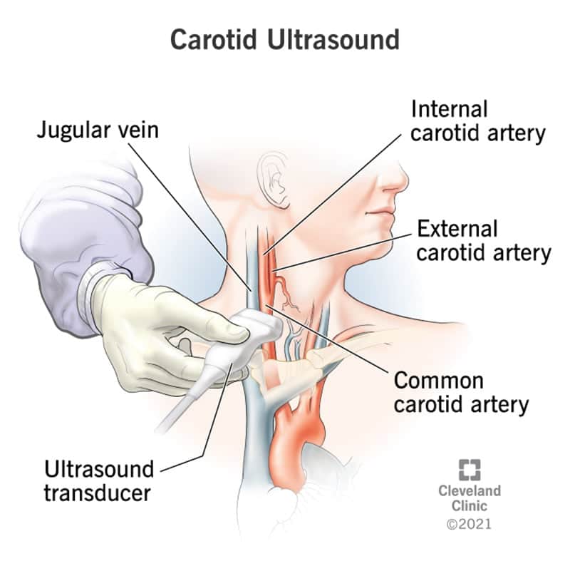 22916 carotid ultrasound
