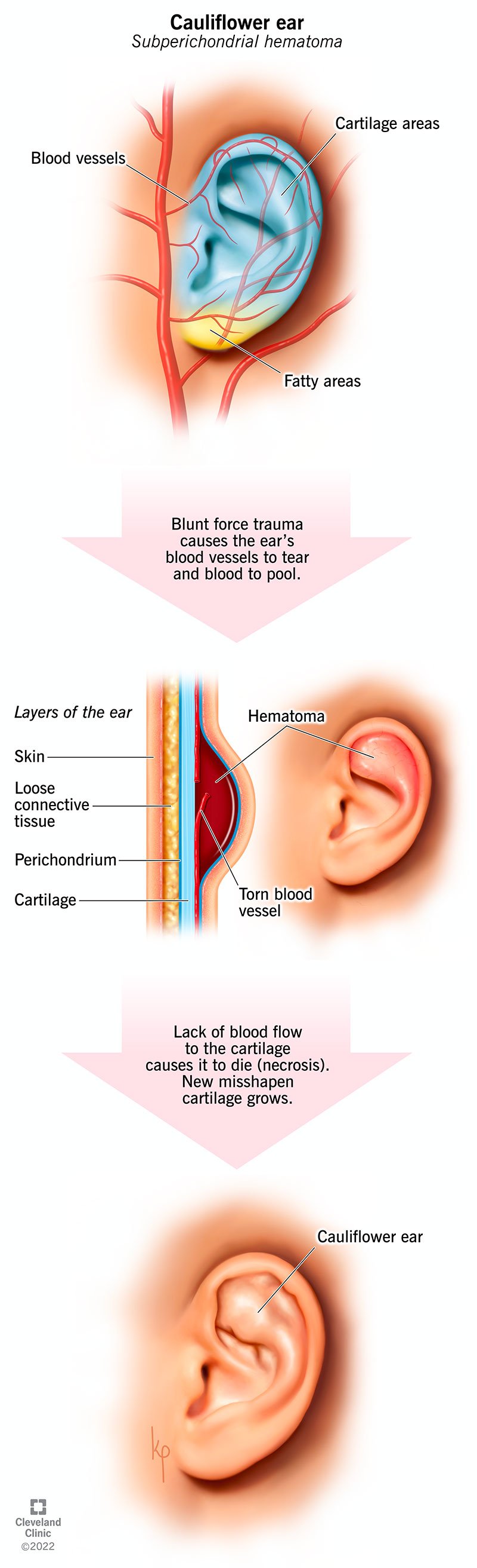 Vooskeem, mis näitab, kuidas nüri jõuga trauma viib lillkapsa kõrvadeni.