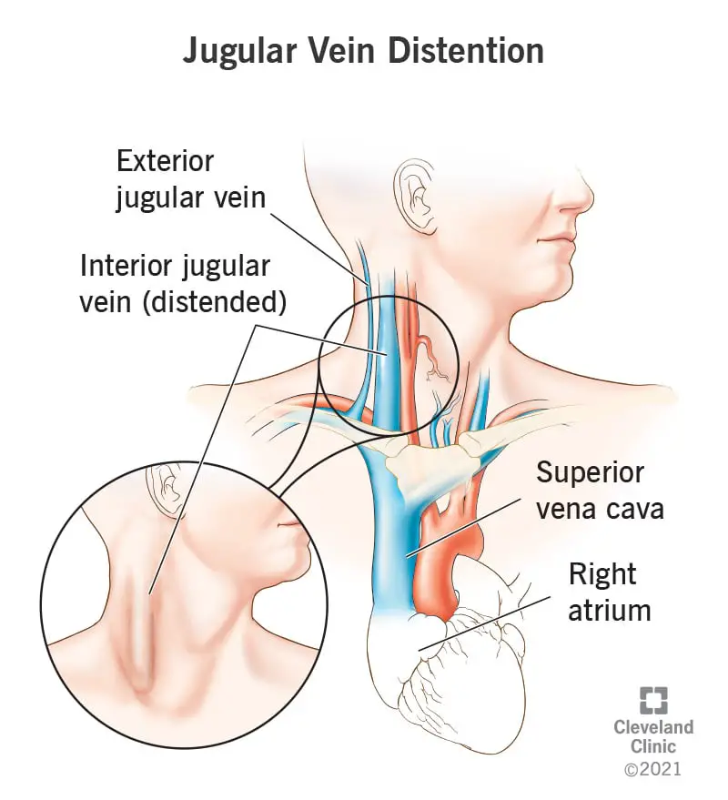 23149 jugular vein distention