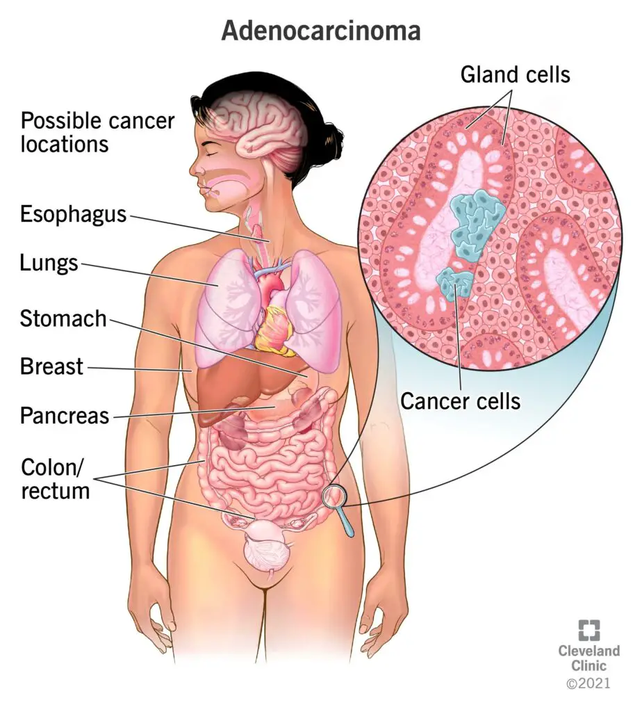 23180 carcinoma