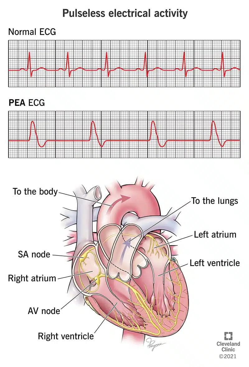 EKG, mis illustreerib impulsivaba elektrilist aktiivsust (PEA)