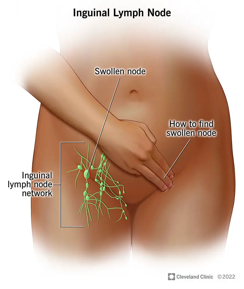 23218 inguinal lymph node