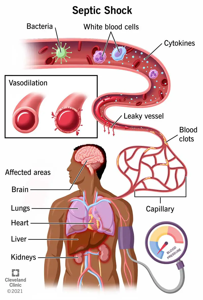 septiline-okk-p-hjused-s-mptomid-ja-ravi-sfomc