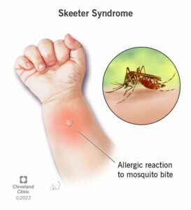 23289 skeeter syndrome