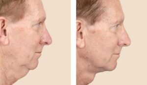 23364 neck lift platysmaplasty