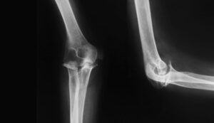 23507 elbow x ray