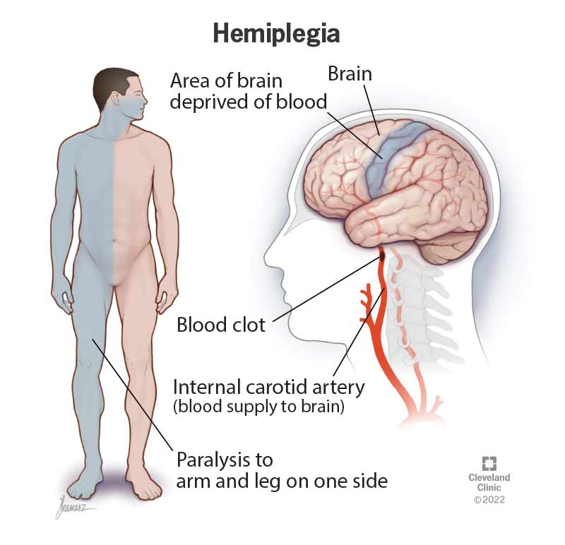 23542 hemiplegia