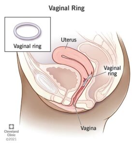 24157 vaginal ring