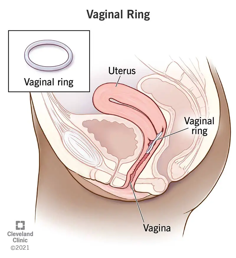 24157 vaginal ring