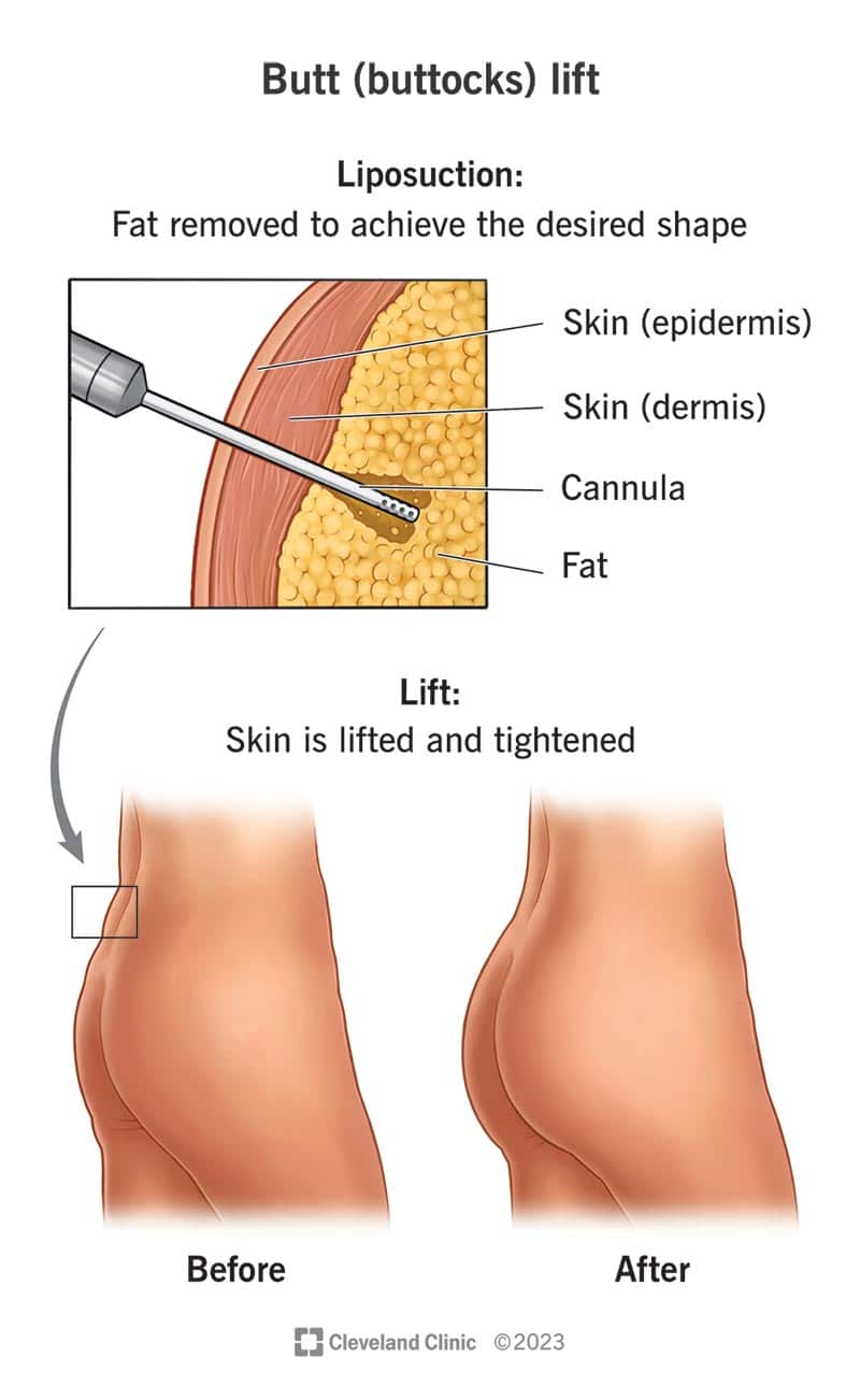 Inimese tagumik enne ja pärast tagumiku (tuharate) tõstmist ning rasvaimu kanüüli tööriist inimese nahas, mida kirurg kasutab rasva eemaldamiseks.