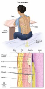 24254 thoracentesis