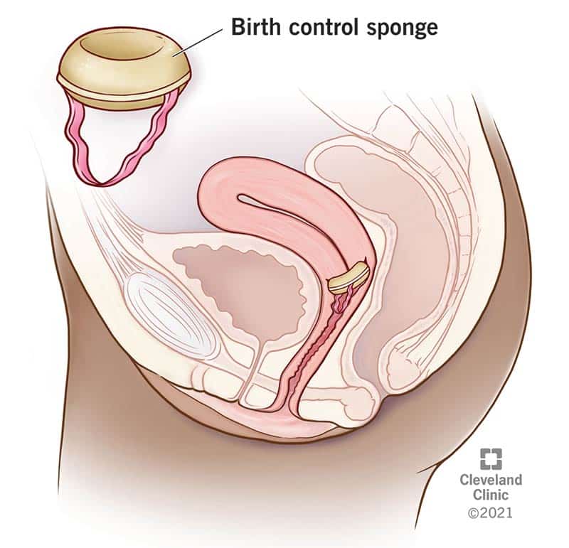 24324 birth control sponge