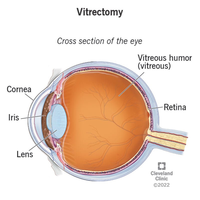 24402 vitrectomy