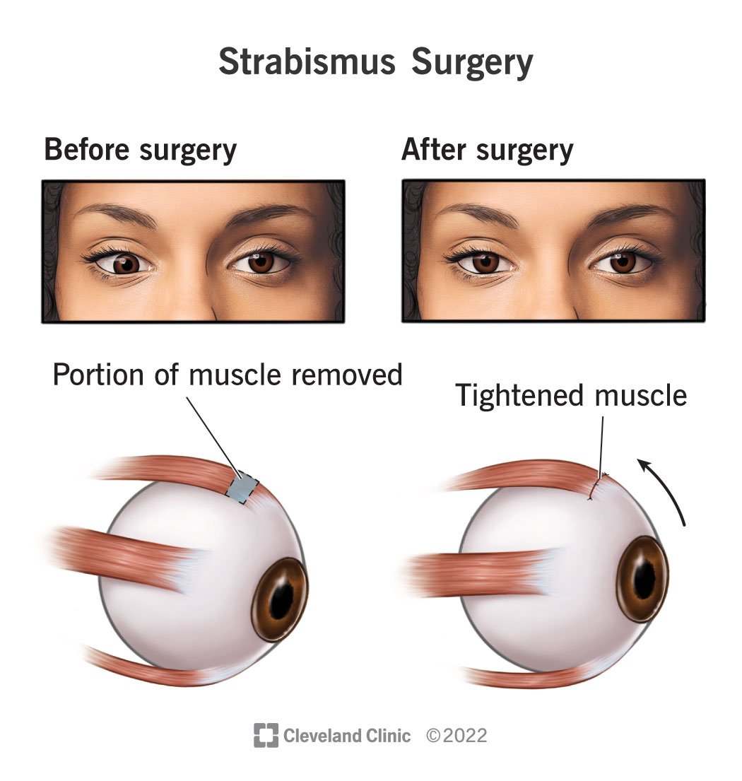 pdf-strabismus-causes-and-treatments-healthclips-online